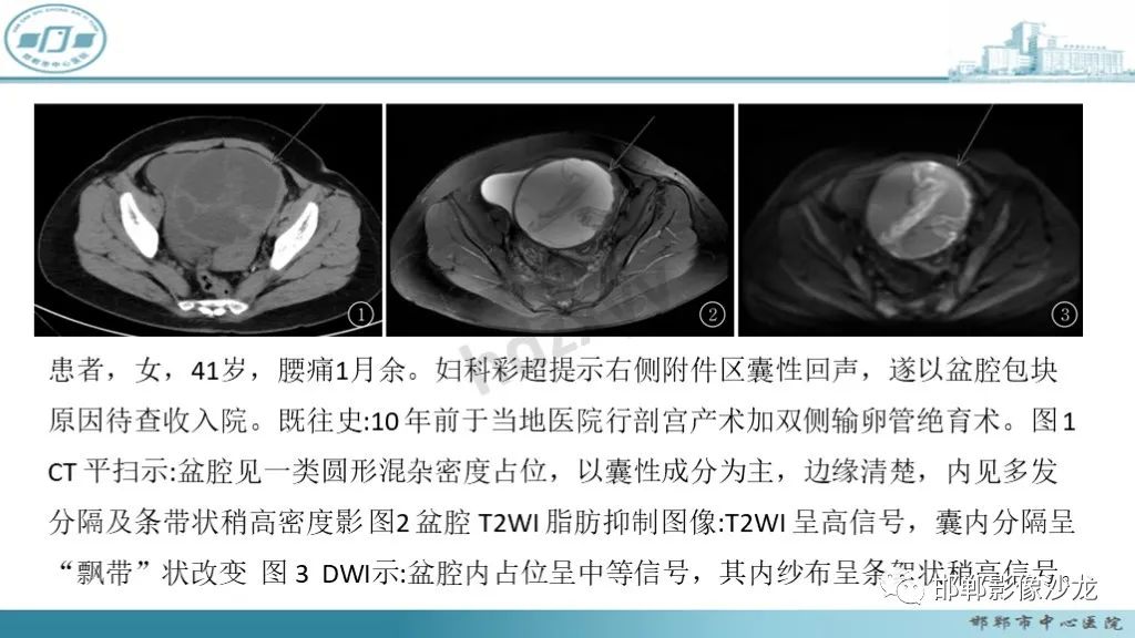 影像PPT - 腹腔内的“蜂窝征”-15 影像PPT - 腹腔内的“蜂窝征”-15
