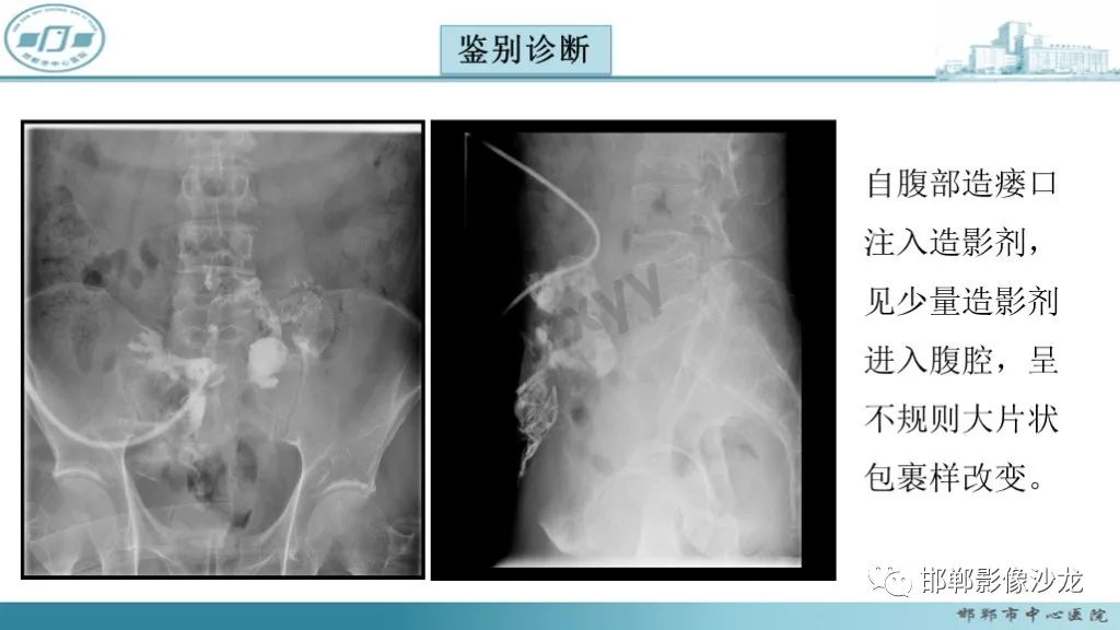 影像PPT - 腹腔内的“蜂窝征”-19 影像PPT - 腹腔内的“蜂窝征”-19