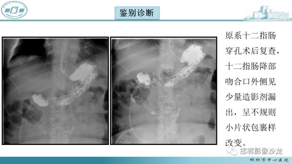 影像PPT - 腹腔内的“蜂窝征”-20 影像PPT - 腹腔内的“蜂窝征”-20