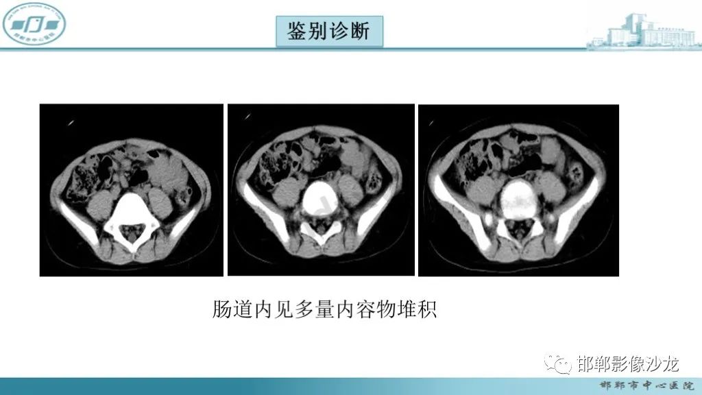 影像PPT - 腹腔内的“蜂窝征”-23 影像PPT - 腹腔内的“蜂窝征”-23
