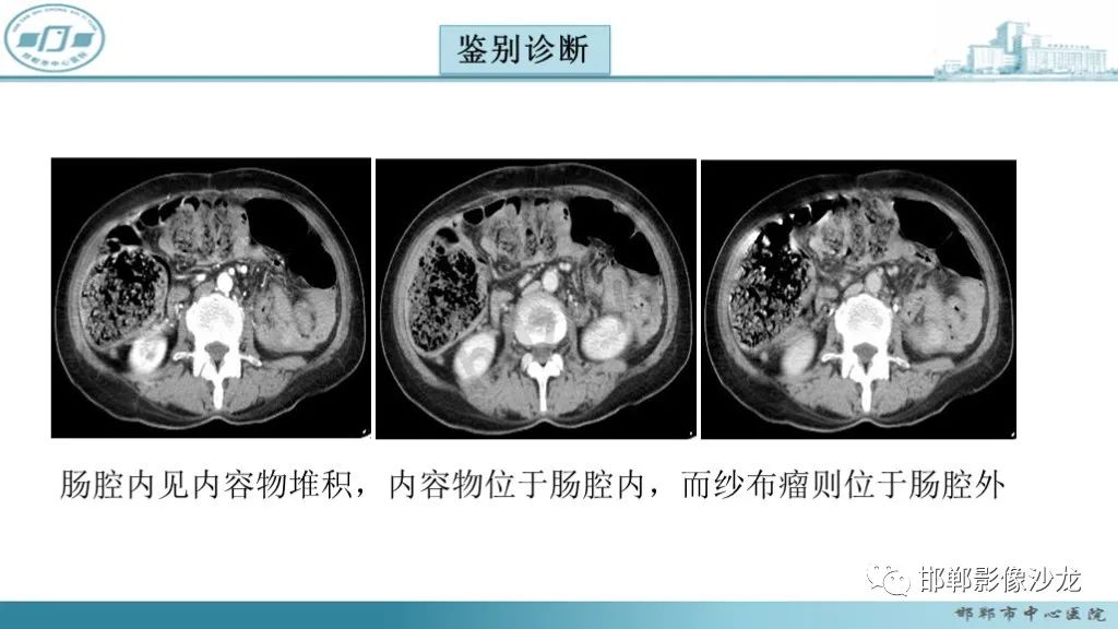 影像PPT - 腹腔内的“蜂窝征”-22 影像PPT - 腹腔内的“蜂窝征”-22