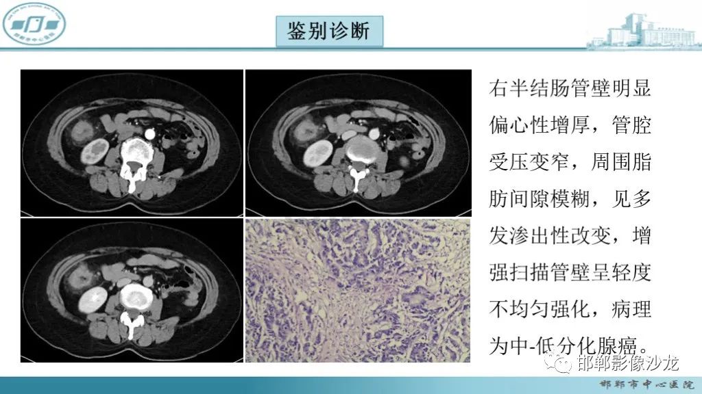 影像PPT - 腹腔内的“蜂窝征”-26 影像PPT - 腹腔内的“蜂窝征”-26