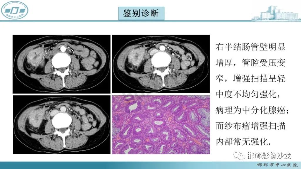 影像PPT - 腹腔内的“蜂窝征”-25 影像PPT - 腹腔内的“蜂窝征”-25
