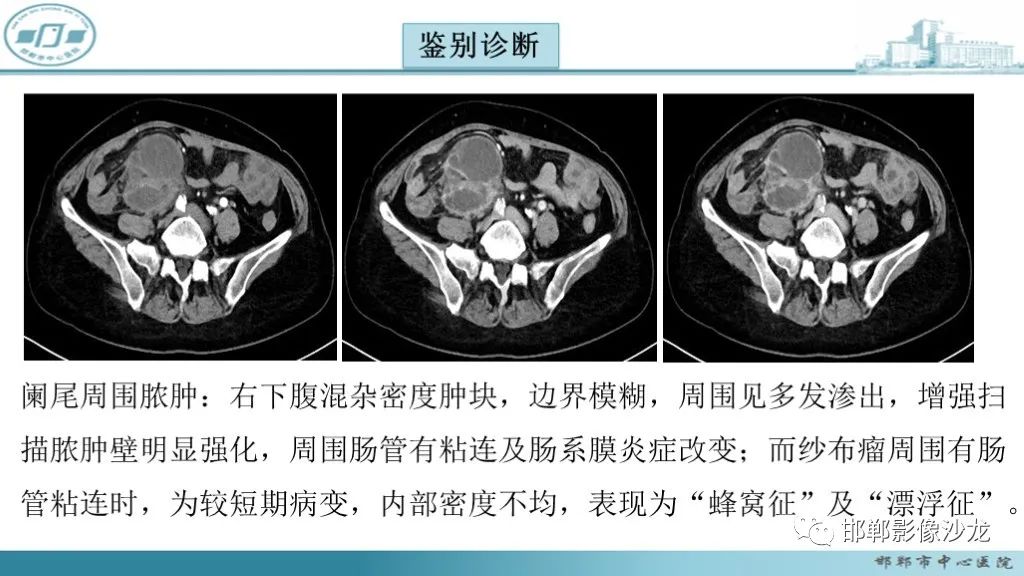 影像PPT - 腹腔内的“蜂窝征”-28 影像PPT - 腹腔内的“蜂窝征”-28