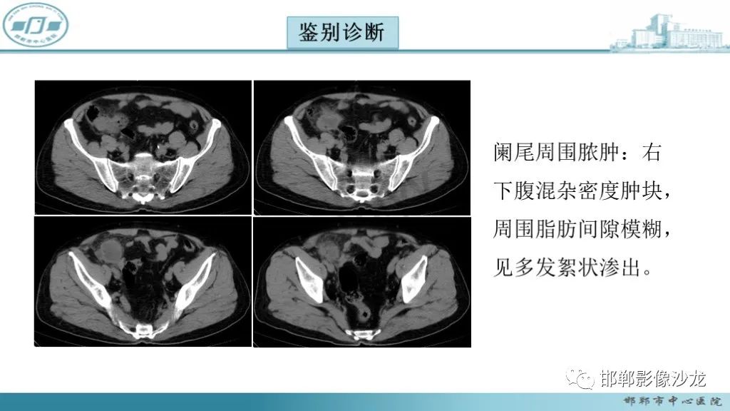 影像PPT - 腹腔内的“蜂窝征”-29 影像PPT - 腹腔内的“蜂窝征”-29