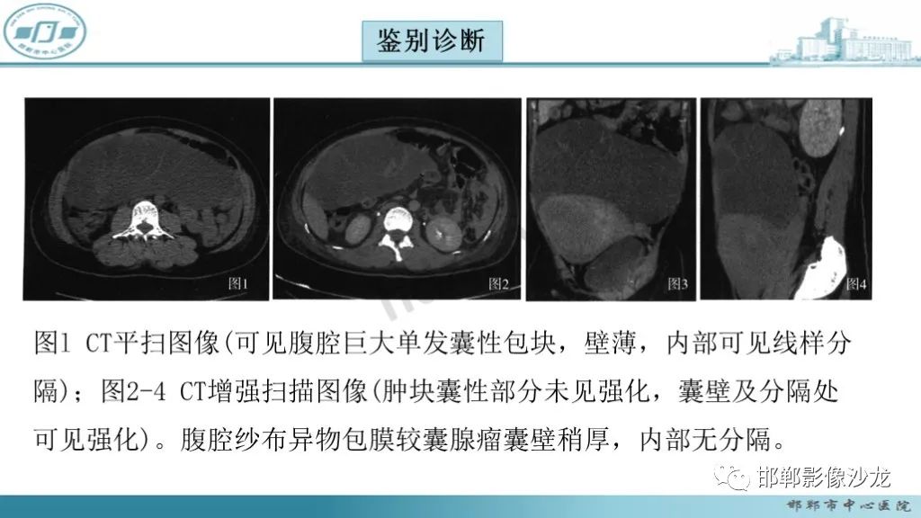 影像PPT - 腹腔内的“蜂窝征”-31 影像PPT - 腹腔内的“蜂窝征”-31