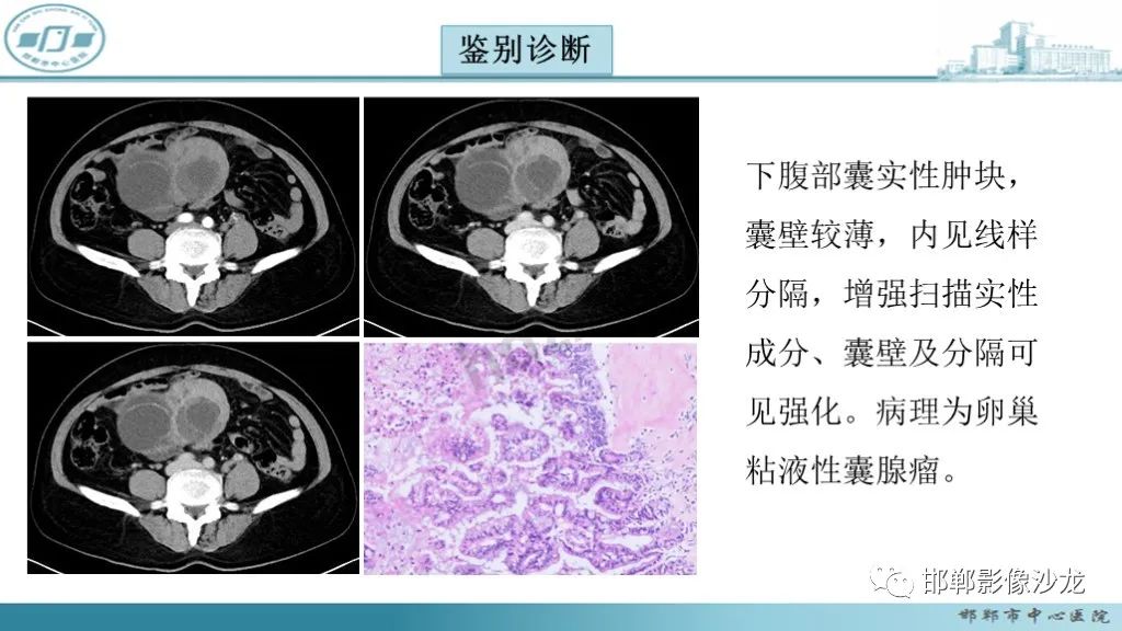 影像PPT - 腹腔内的“蜂窝征”-32 影像PPT - 腹腔内的“蜂窝征”-32