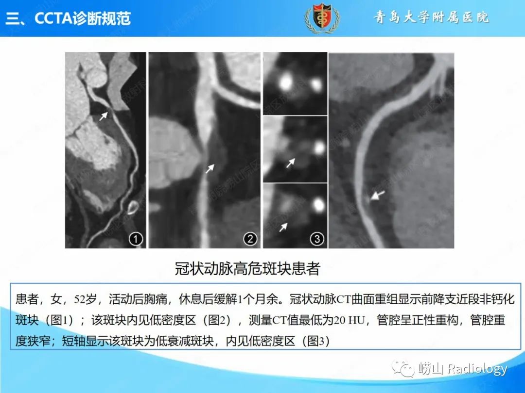 影像PPT - 【PPT】冠状动脉CT血管成像最新临床应用推荐及诊断规范-17