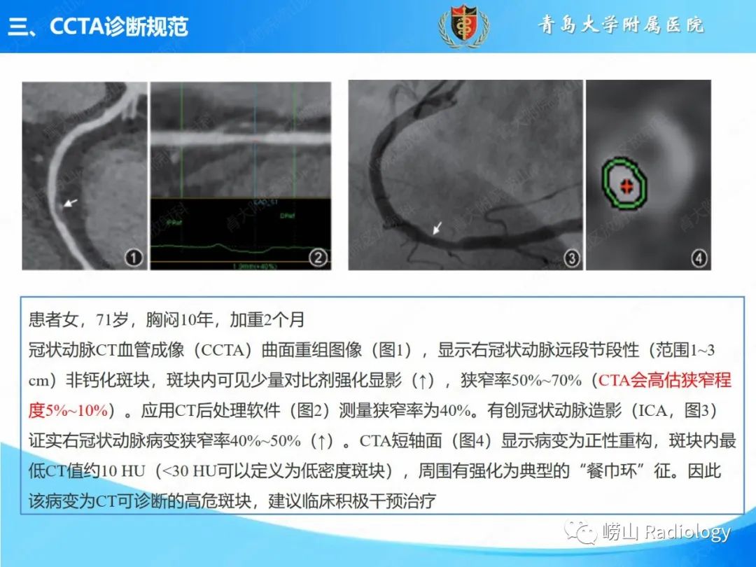 影像PPT - 【PPT】冠状动脉CT血管成像最新临床应用推荐及诊断规范-20