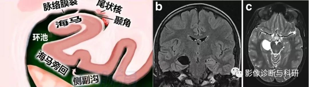 影像PPT - 海马的解剖及疾病谱影像诊断-7 影像PPT - 海马的解剖及疾病谱影像诊断-7