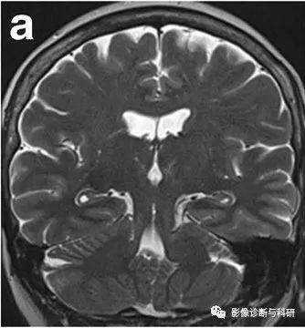 影像PPT - 海马的解剖及疾病谱影像诊断-6 影像PPT - 海马的解剖及疾病谱影像诊断-6