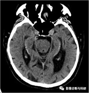影像PPT - 海马的解剖及疾病谱影像诊断-10 影像PPT - 海马的解剖及疾病谱影像诊断-10