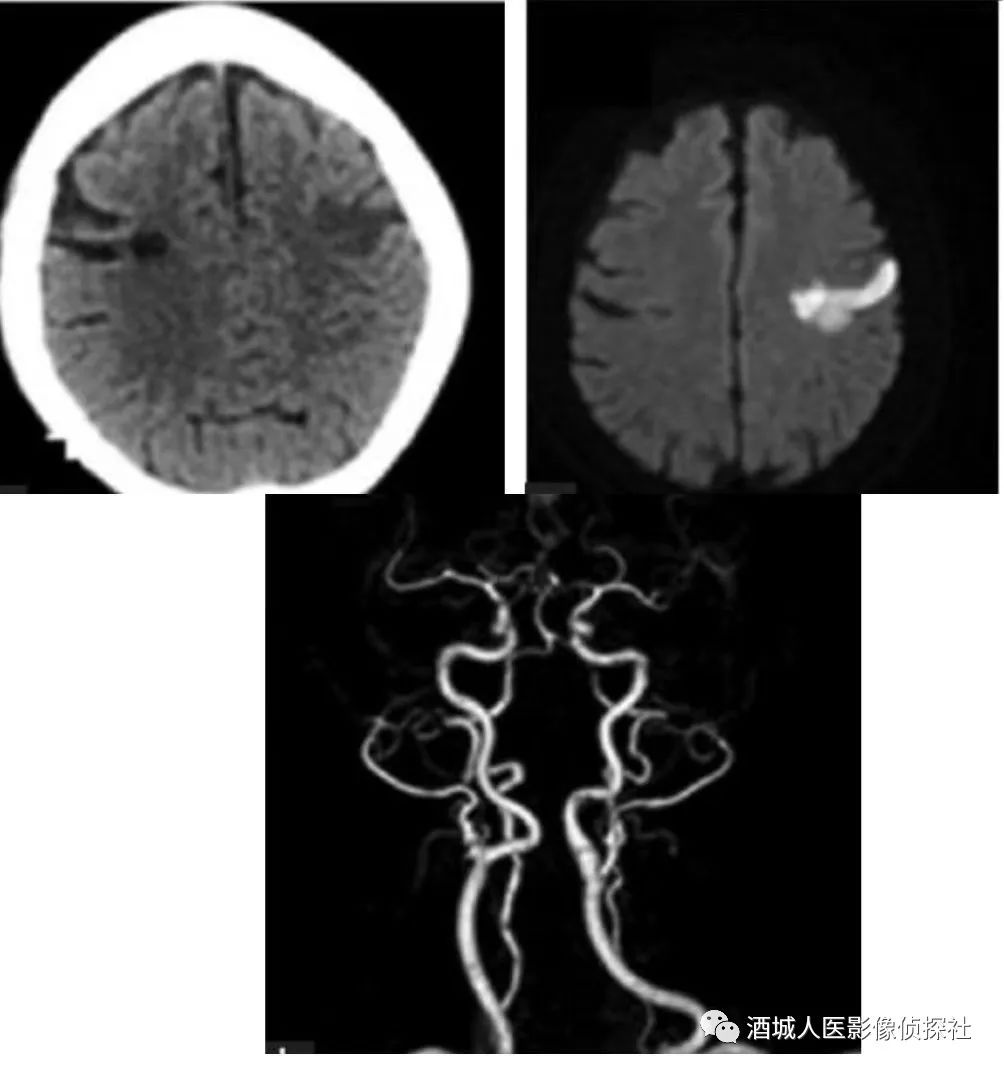影像PPT - 岛盖综合征(Opercular syndrome)-1 影像PPT - 岛盖综合征(Opercular syndrome)-1