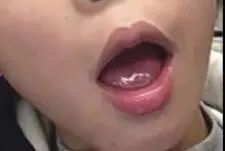 影像PPT - 岛盖综合征(Opercular syndrome)-2 影像PPT - 岛盖综合征(Opercular syndrome)-2