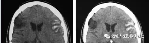 影像PPT - 岛盖综合征(Opercular syndrome)-4 影像PPT - 岛盖综合征(Opercular syndrome)-4
