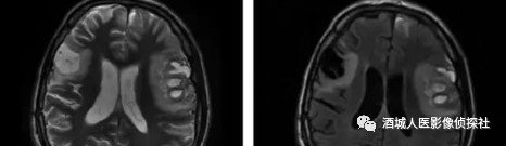 影像PPT - 岛盖综合征(Opercular syndrome)-5 影像PPT - 岛盖综合征(Opercular syndrome)-5