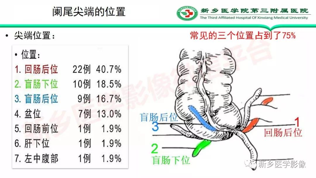 影像PPT - 【PPT】急性阑尾炎的CT诊断-6