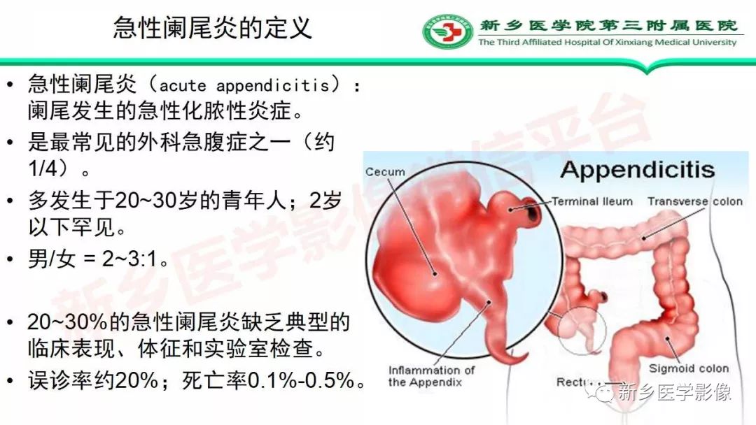 影像PPT - 【PPT】急性阑尾炎的CT诊断-7