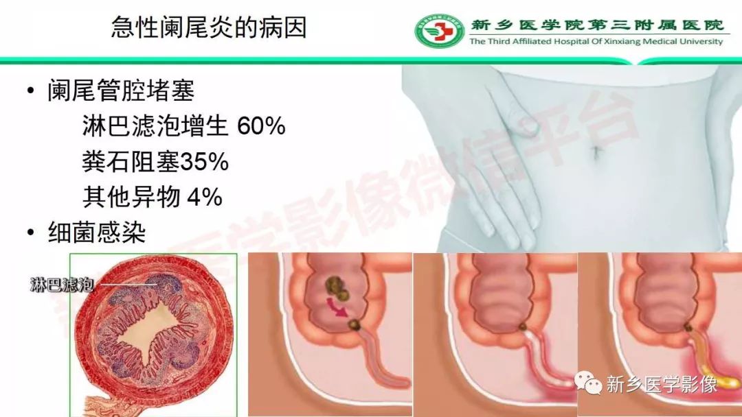 影像PPT - 【PPT】急性阑尾炎的CT诊断-8