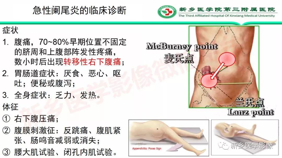 影像PPT - 【PPT】急性阑尾炎的CT诊断-9