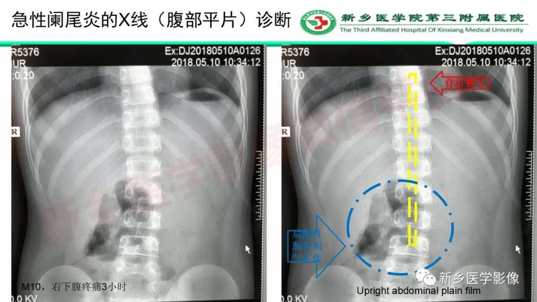 影像PPT - 【PPT】急性阑尾炎的CT诊断-12