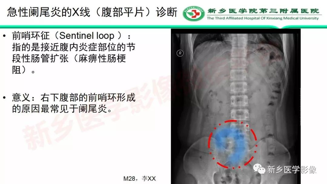 影像PPT - 【PPT】急性阑尾炎的CT诊断-13