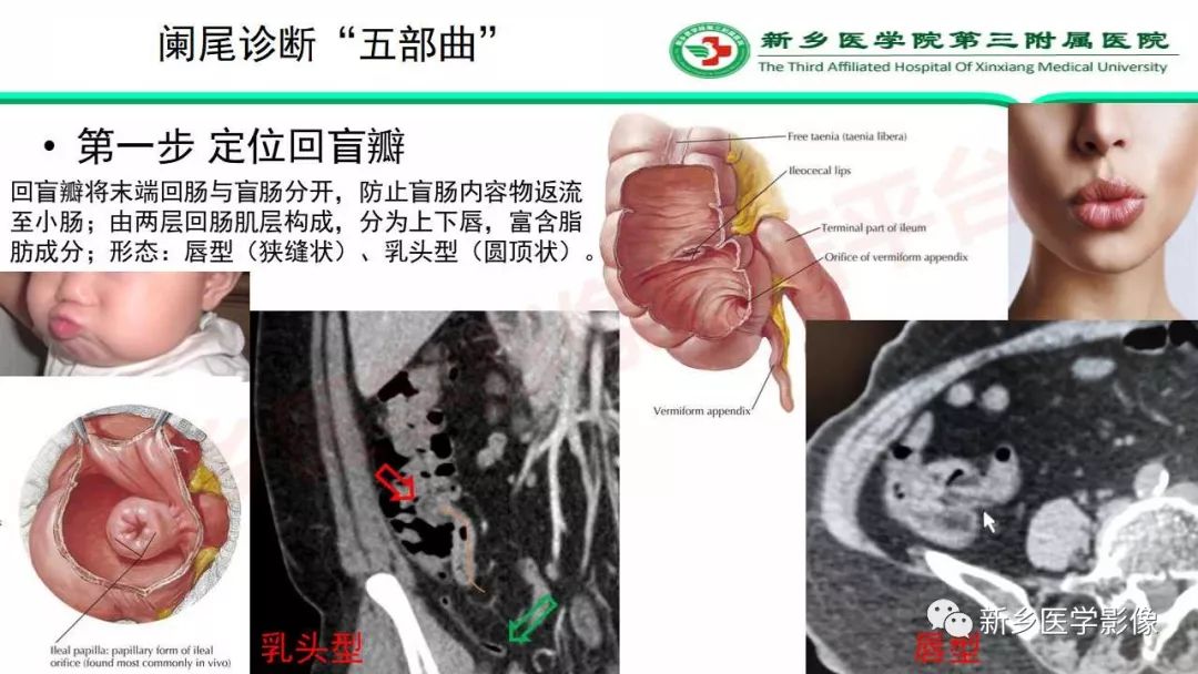 影像PPT - 【PPT】急性阑尾炎的CT诊断-15