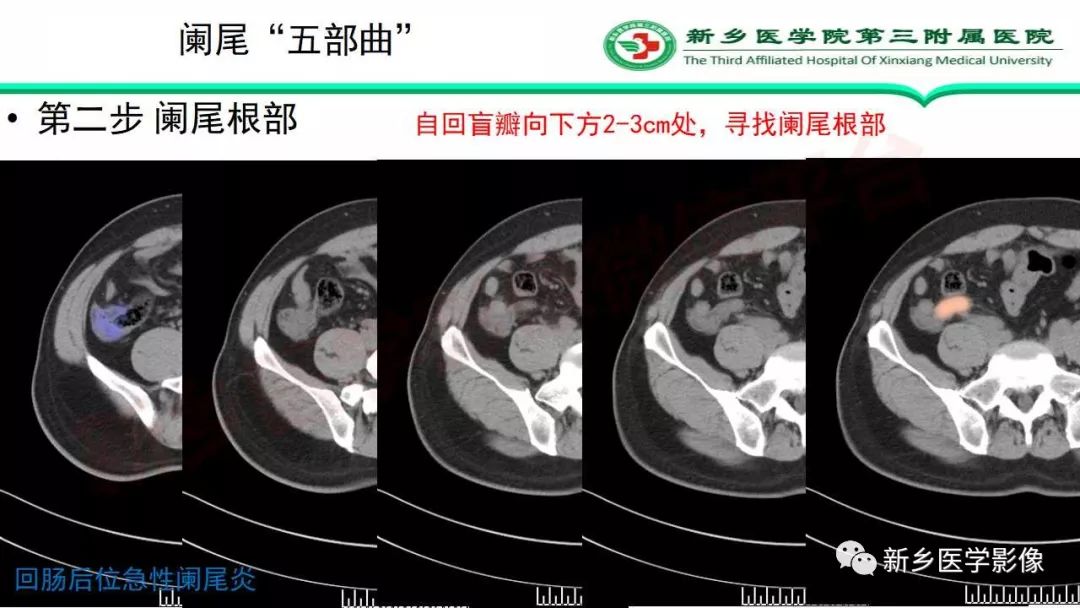 影像PPT - 【PPT】急性阑尾炎的CT诊断-17
