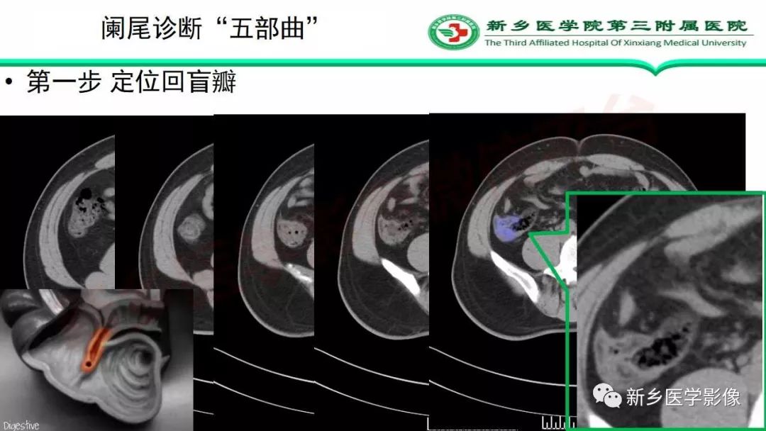 影像PPT - 【PPT】急性阑尾炎的CT诊断-16