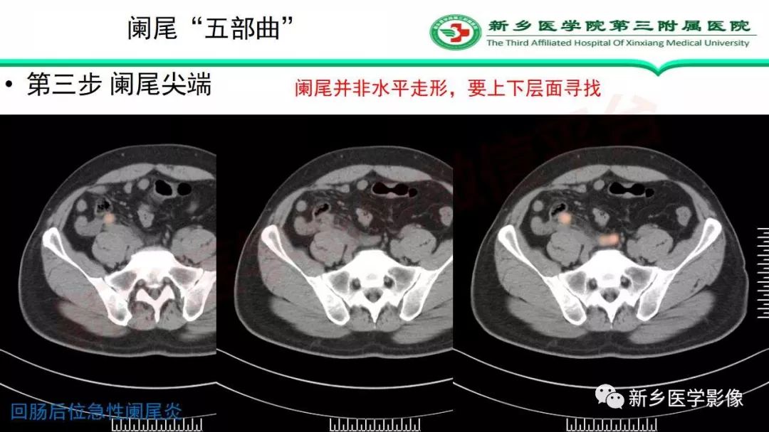 影像PPT - 【PPT】急性阑尾炎的CT诊断-18