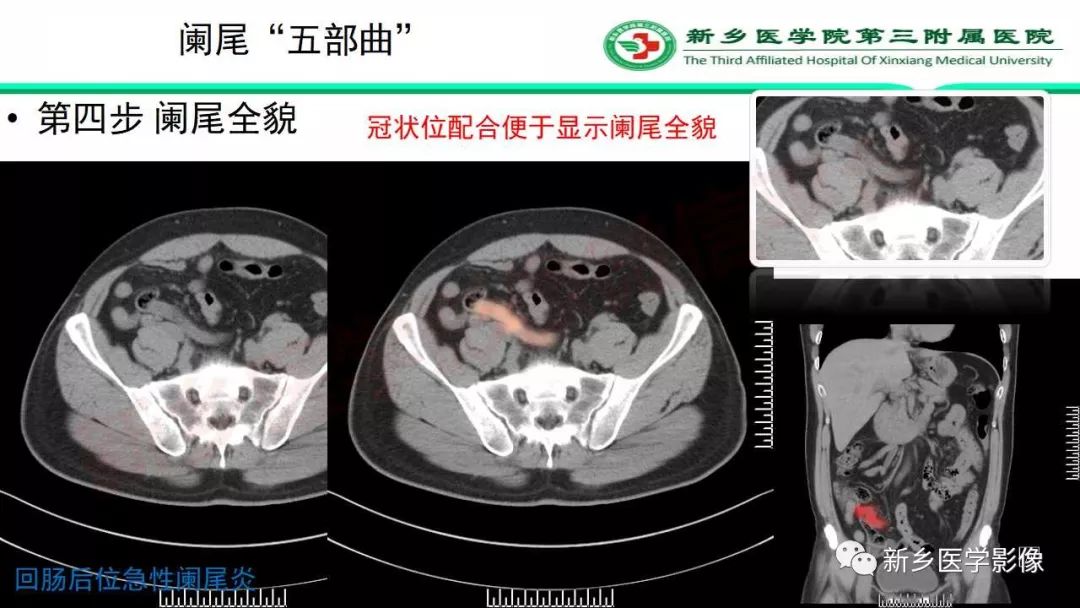 影像PPT - 【PPT】急性阑尾炎的CT诊断-19