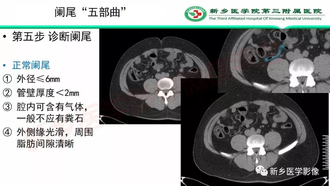 影像PPT - 【PPT】急性阑尾炎的CT诊断-20
