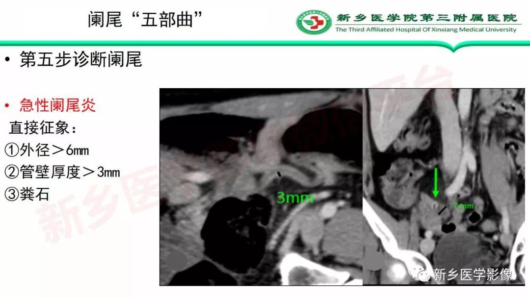 影像PPT - 【PPT】急性阑尾炎的CT诊断-21