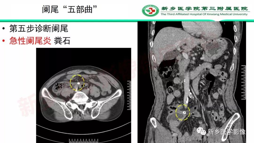 影像PPT - 【PPT】急性阑尾炎的CT诊断-22