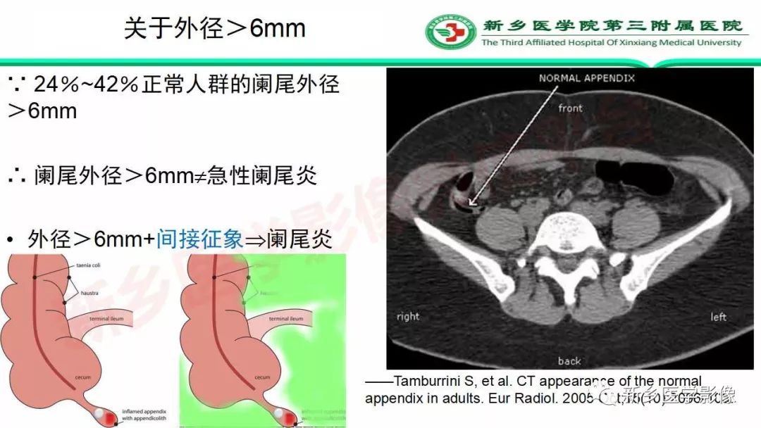 影像PPT - 【PPT】急性阑尾炎的CT诊断-23