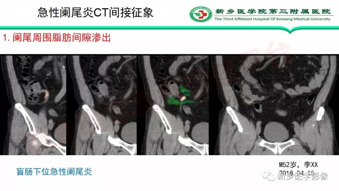影像PPT - 【PPT】急性阑尾炎的CT诊断-24