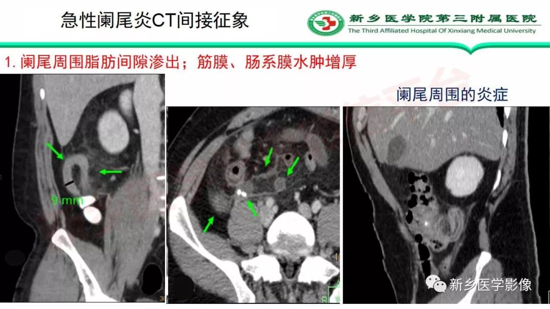 影像PPT - 【PPT】急性阑尾炎的CT诊断-25