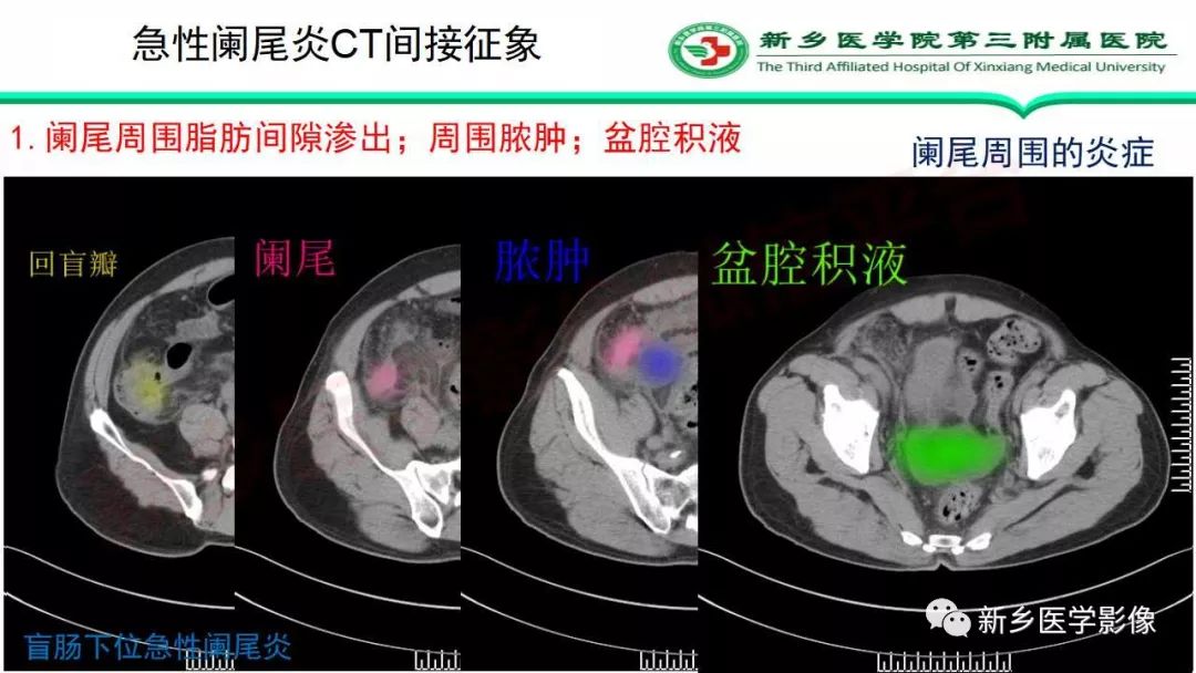 影像PPT - 【PPT】急性阑尾炎的CT诊断-26