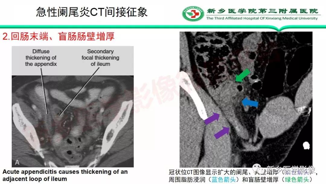 影像PPT - 【PPT】急性阑尾炎的CT诊断-27
