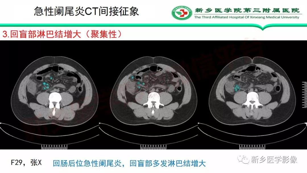影像PPT - 【PPT】急性阑尾炎的CT诊断-28