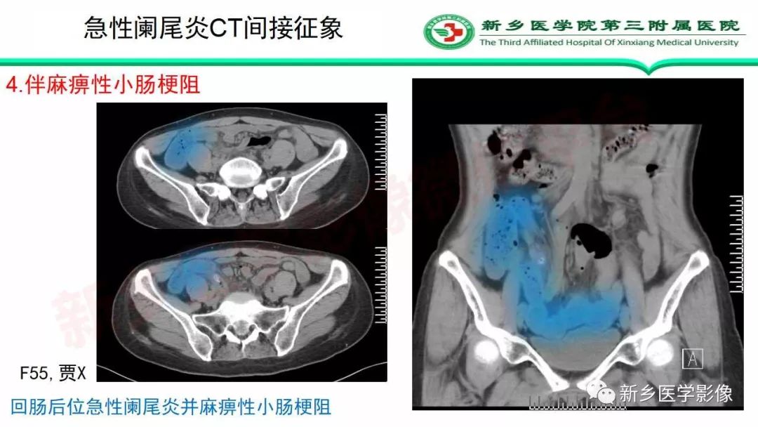 影像PPT - 【PPT】急性阑尾炎的CT诊断-29