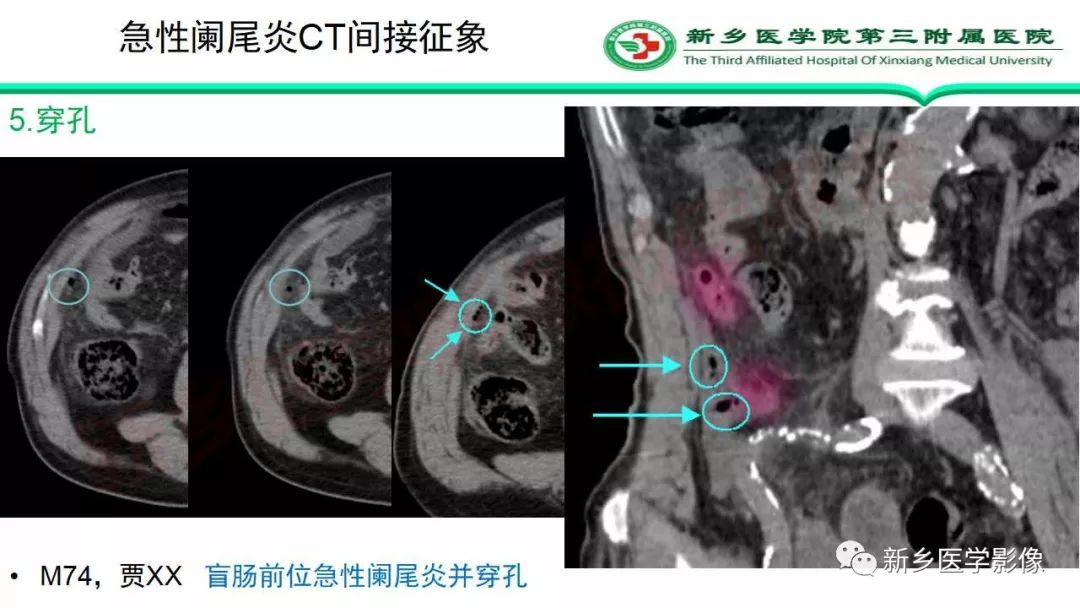 影像PPT - 【PPT】急性阑尾炎的CT诊断-31