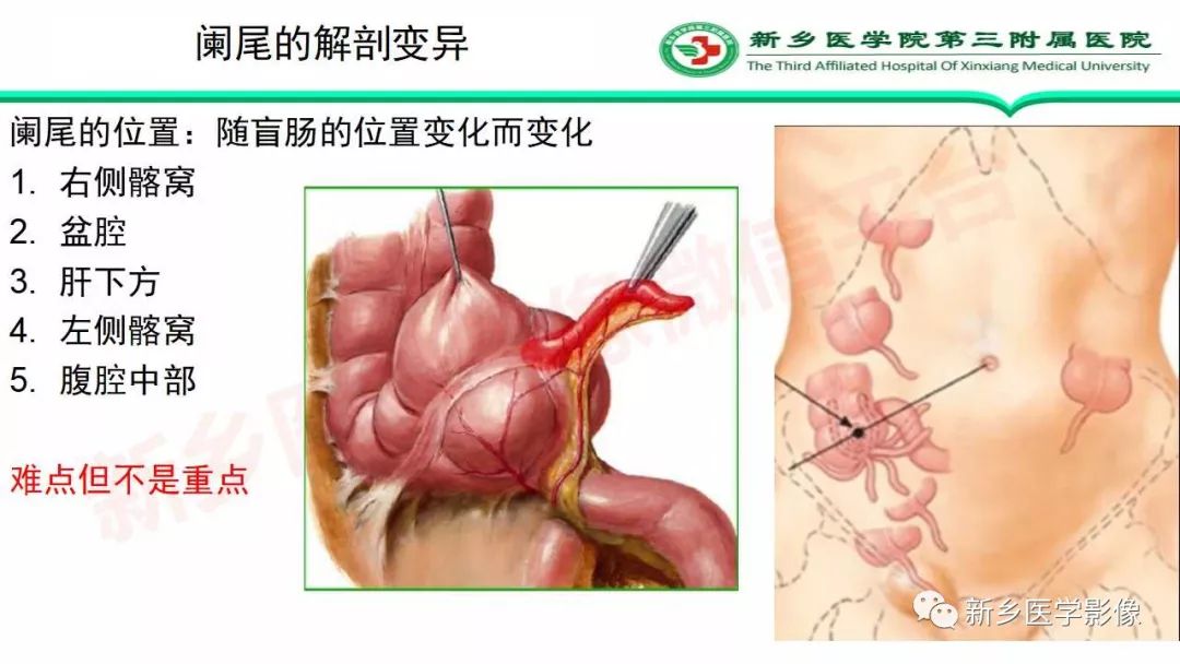 影像PPT - 【PPT】急性阑尾炎的CT诊断-33