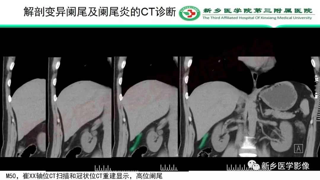 影像PPT - 【PPT】急性阑尾炎的CT诊断-34