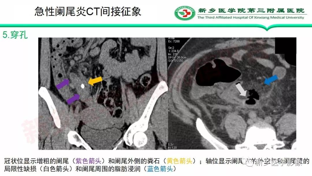 影像PPT - 【PPT】急性阑尾炎的CT诊断-32
