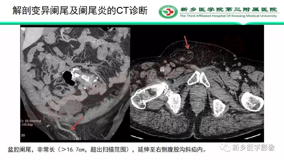 影像PPT - 【PPT】急性阑尾炎的CT诊断-35