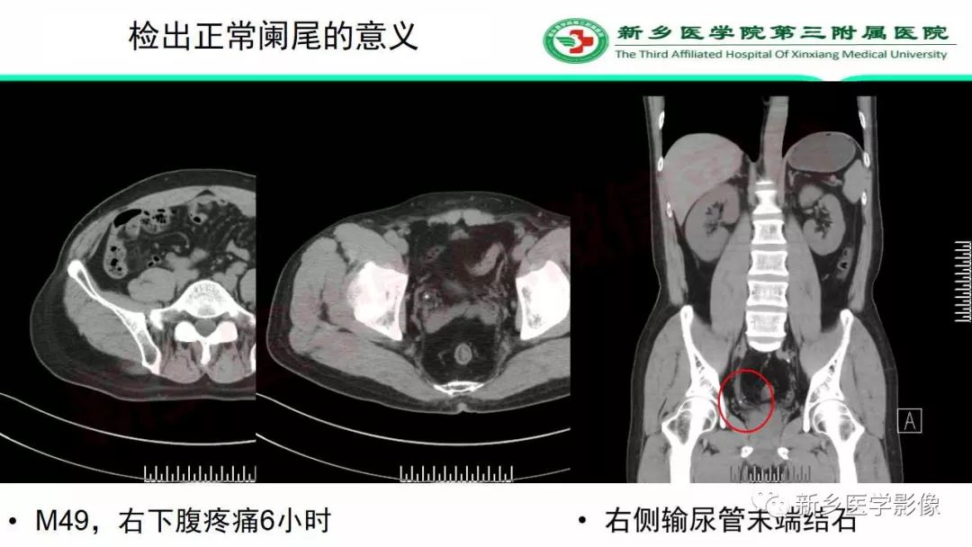 影像PPT - 【PPT】急性阑尾炎的CT诊断-37
