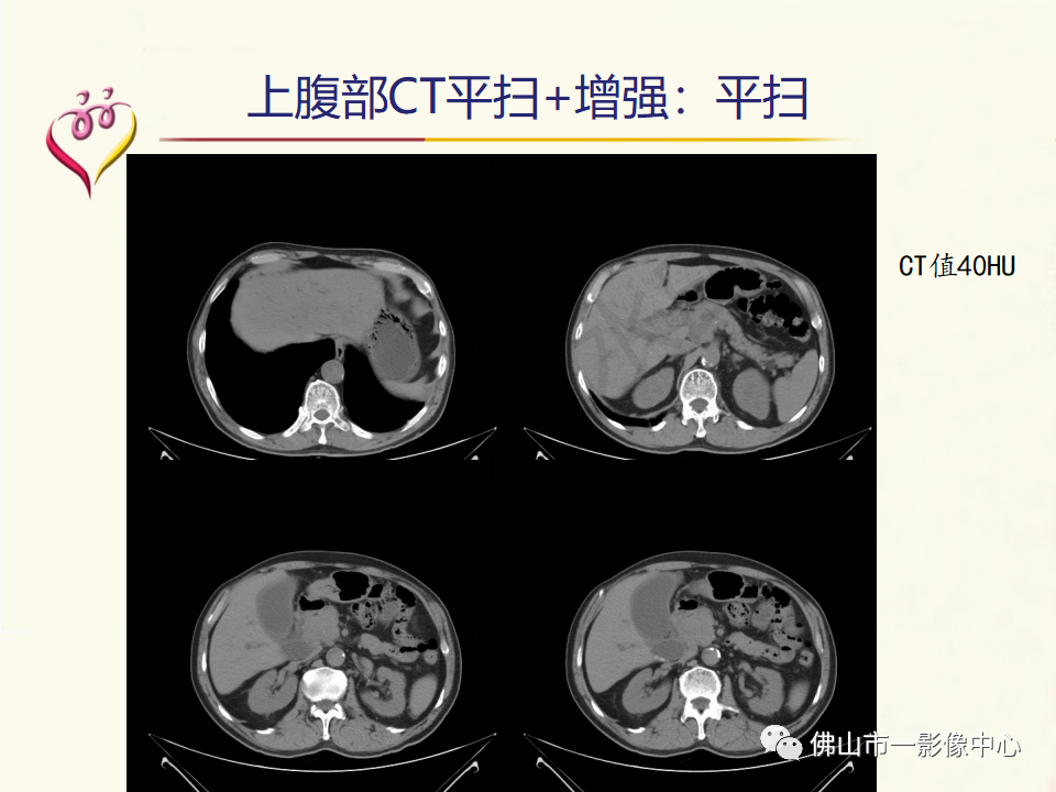 影像PPT - 【病例】胰腺淋巴瘤1例CT及MR影像-4