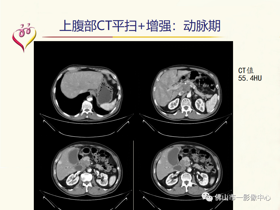 影像PPT - 【病例】胰腺淋巴瘤1例CT及MR影像-5