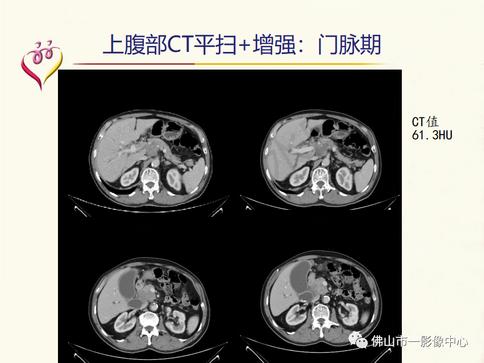 影像PPT - 【病例】胰腺淋巴瘤1例CT及MR影像-6